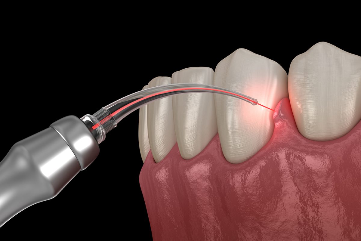 Periodontita-arstesana-1200x801.jpg